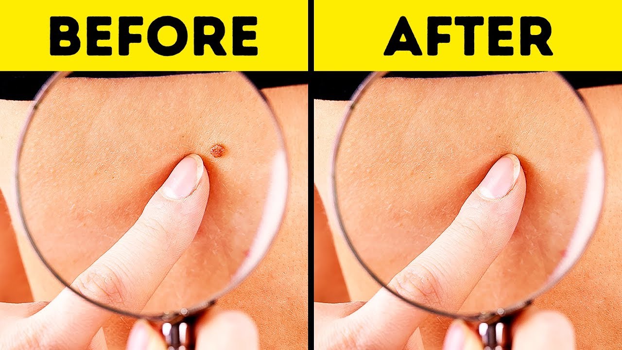 How to remove skin tags in one night naturally