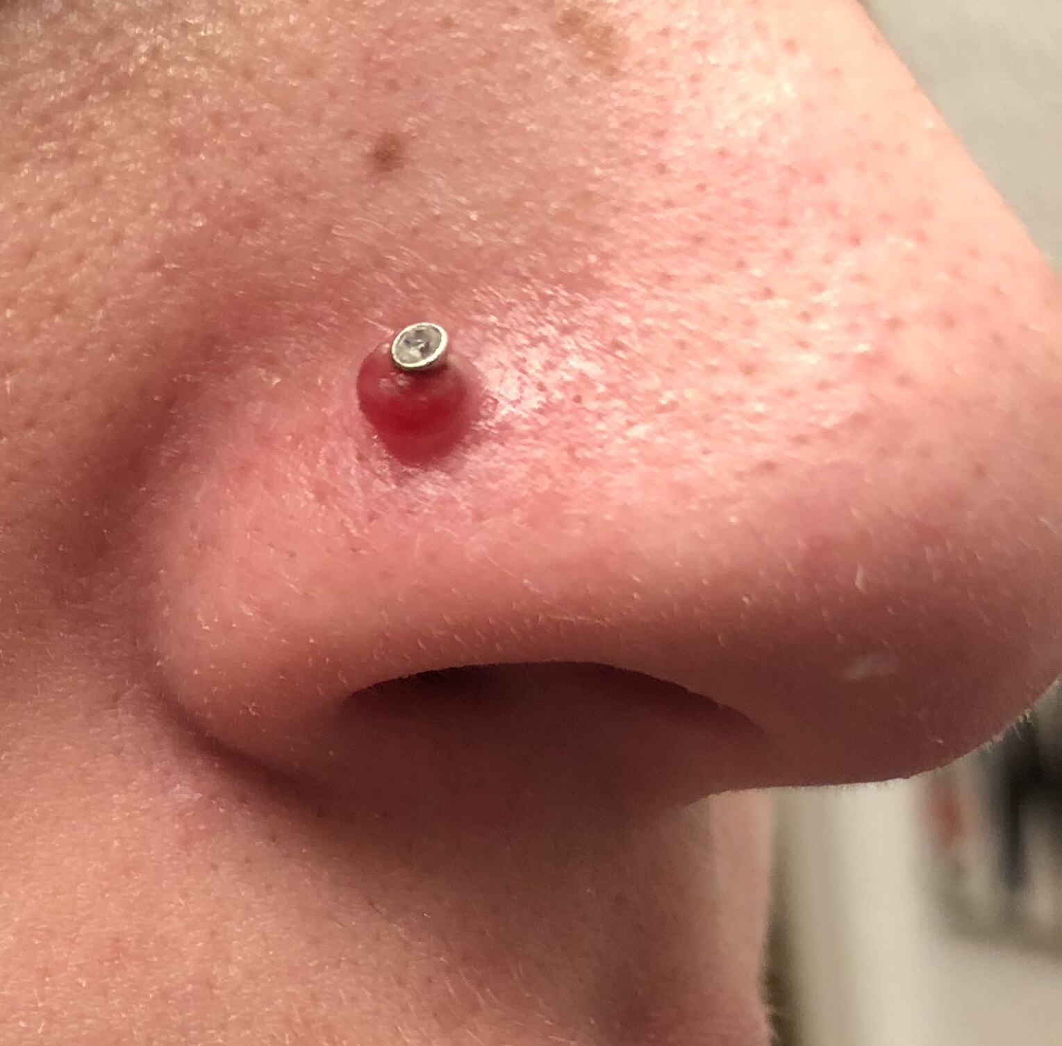 How to Get Rid of a Piercing Bump